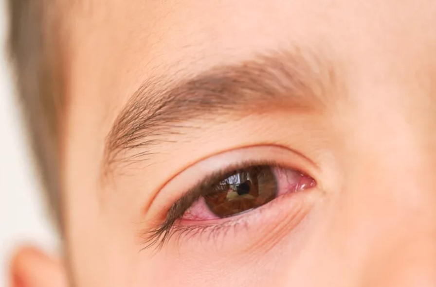 2023 04 19 XBB.1.16 new sympton red eye